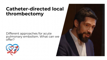 Catheter-directed local thrombectomy