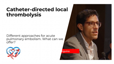 Catheter-directed local thrombolysis